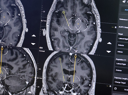 Estimulação cerebral profunda: uma revolução no tratamento da doença de Parkinson