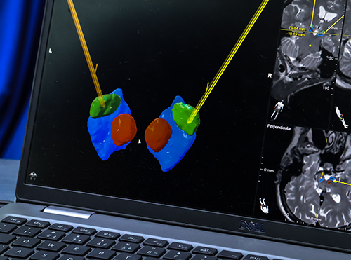 O papel da tecnologia 3D na preparação de cirurgias para doença de Parkinson
