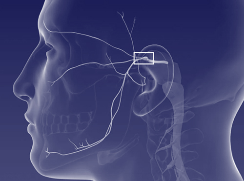 Termocoagulação por radiofrequência no tratamento da neuralgia do trigêmeo